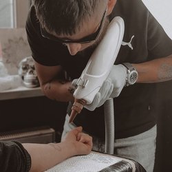 Tattoo Removal