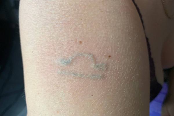 tattoo lightening with remover procedure on tattoo area